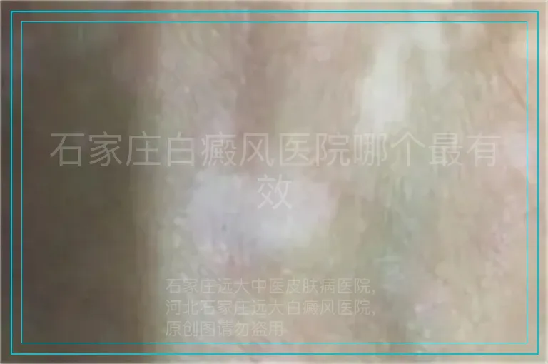 石家庄白癜风医院哪个最有效