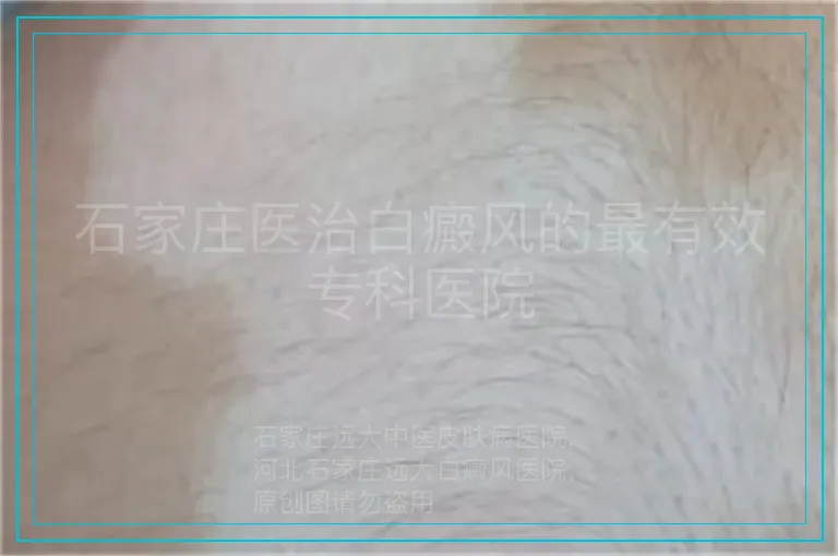 石家庄医治白癜风的最有效专科医院