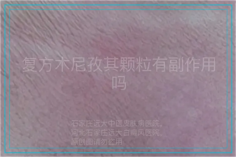 复方木尼孜其颗粒有副作用吗