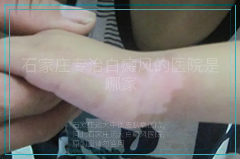 石家庄专治白癜风的医院是哪家