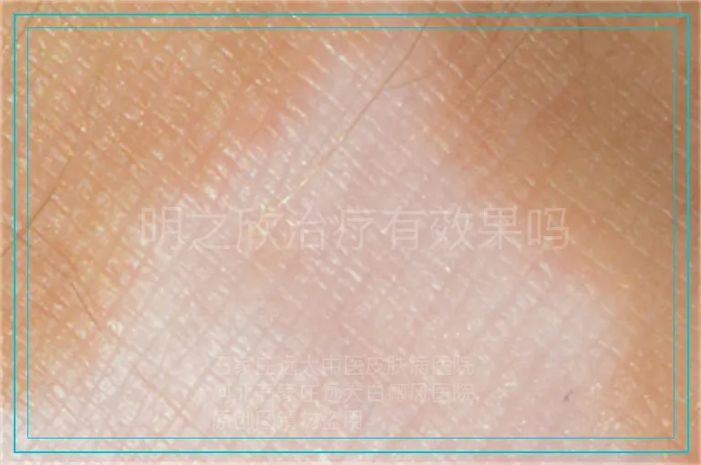 明之欣治疗有效果吗