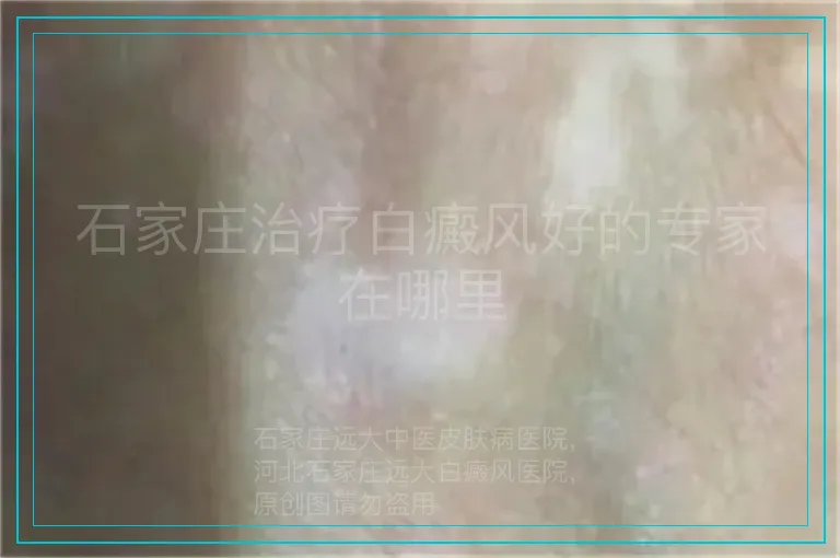 石家庄治疗白癜风好的专家在哪里