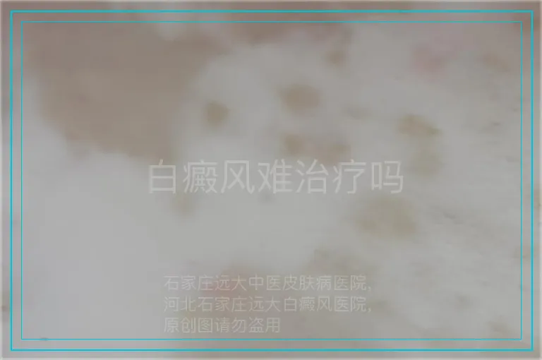 白癜风难治疗吗