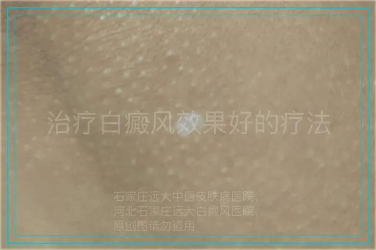 治疗白癜风效果好的疗法