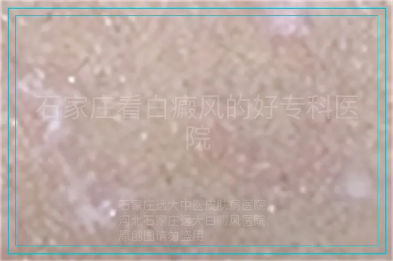 石家庄看白癜风的好专科医院