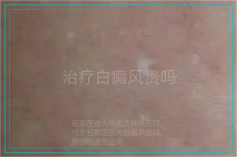 治疗白癜风贵吗