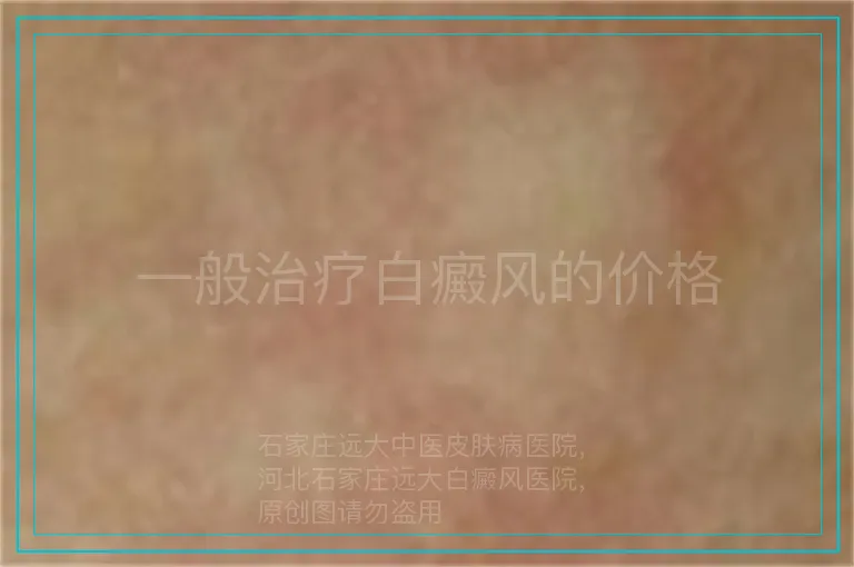 一般治疗白癜风的价格