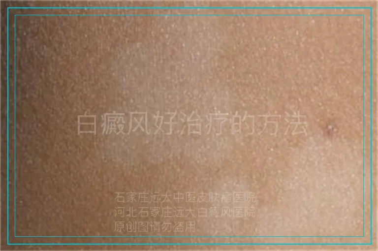 白癜风好治疗的方法