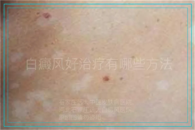 白癜风好治疗有哪些方法