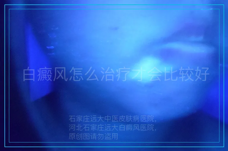 白癜风怎么治疗才会比较好