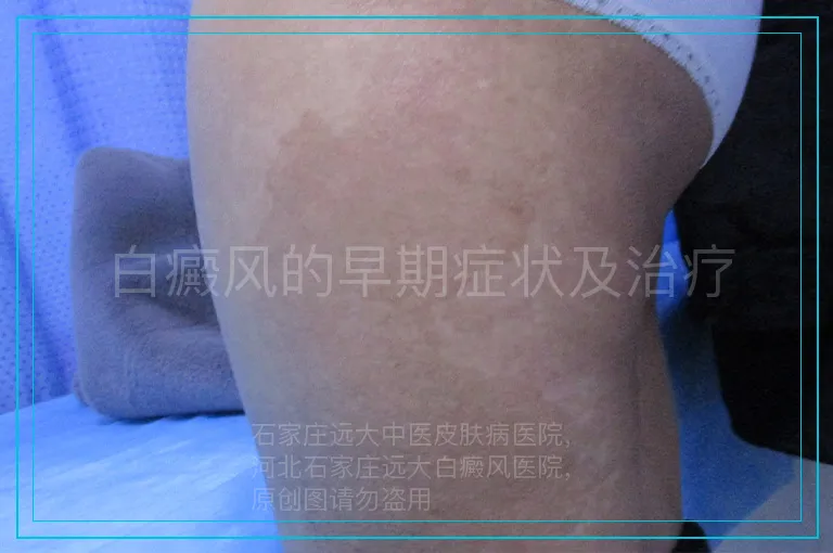 白癜风的早期症状及治疗