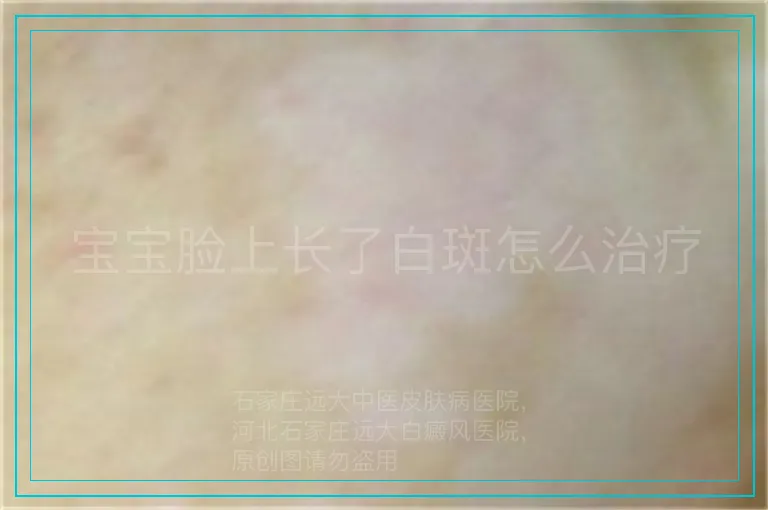 宝宝脸上长了白斑怎么治疗