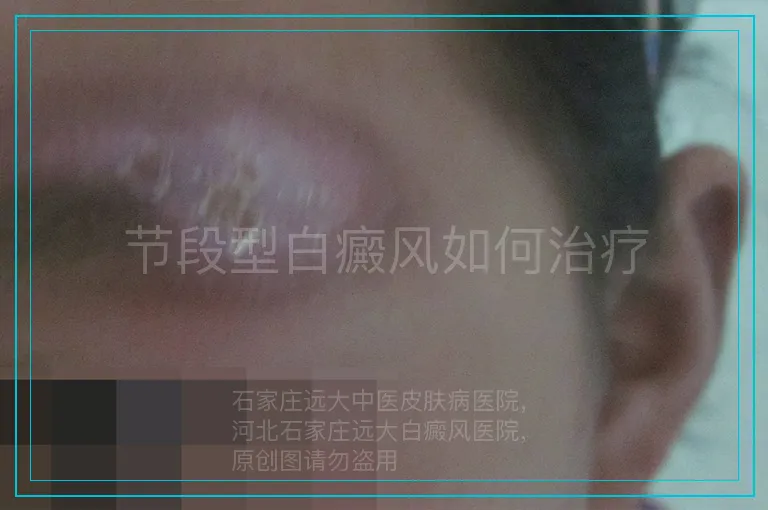 节段型白癜风如何治疗