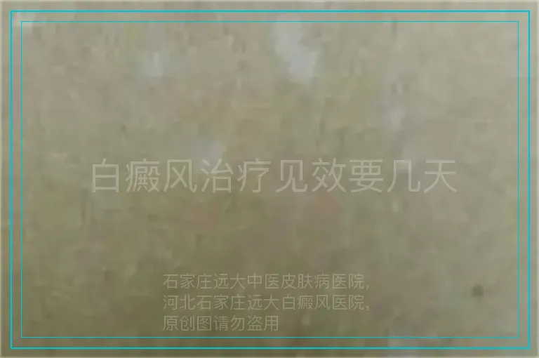 白癜风治疗见效要几天