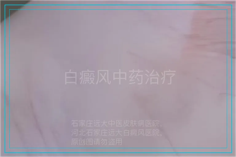 白癜风中药治疗