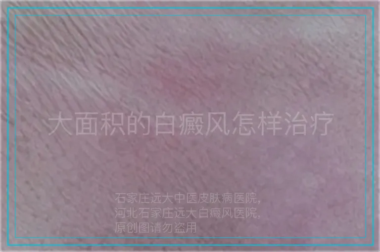 大面积的白癜风怎样治疗