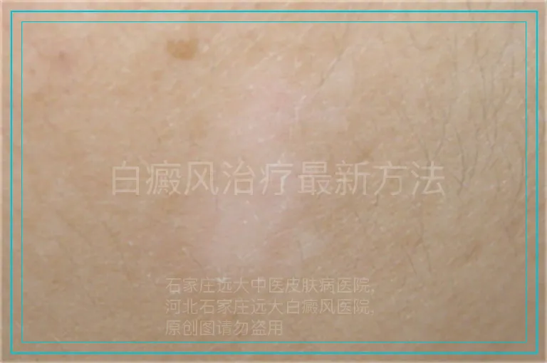 白癜风治疗最新方法