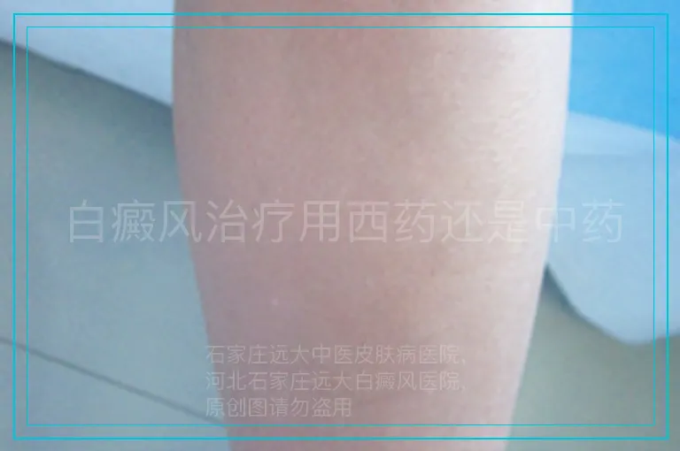 白癜风治疗用西药还是中药