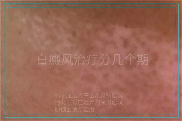 白癜风治疗分几个期