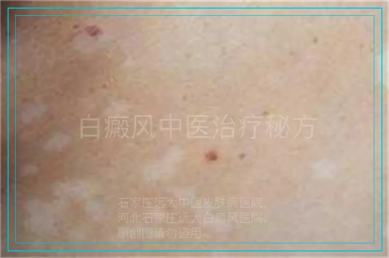 白癜风中医治疗秘方