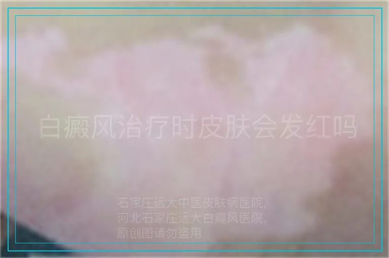 白癜风治疗时皮肤会发红吗