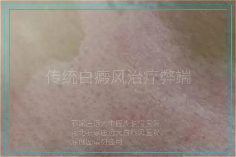 传统白癜风治疗弊端