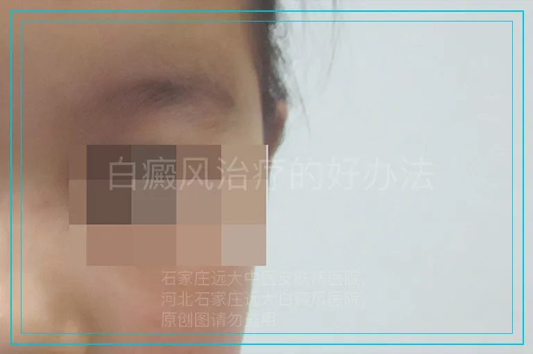 白癜风治疗的好办法