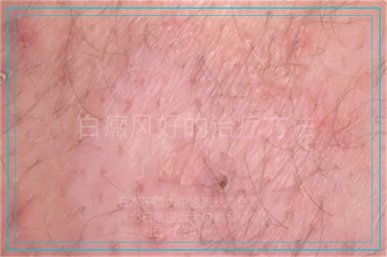 白癜风好的治疗方法