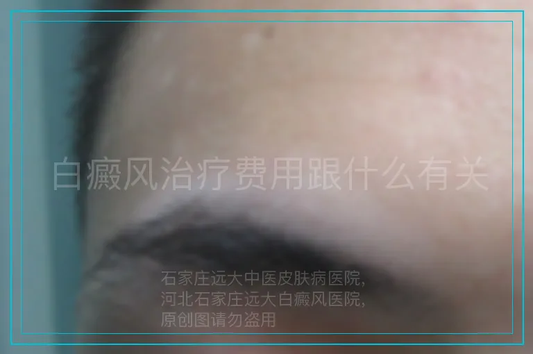 白癜风治疗费用跟什么有关