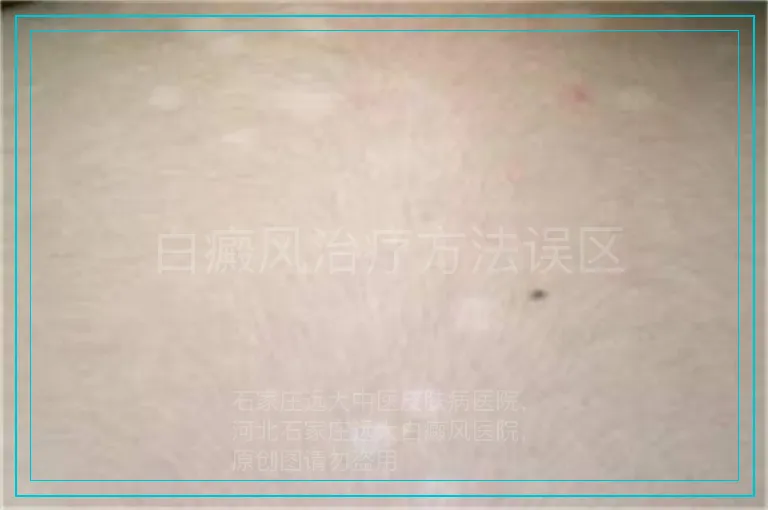 白癜风治疗方法误区