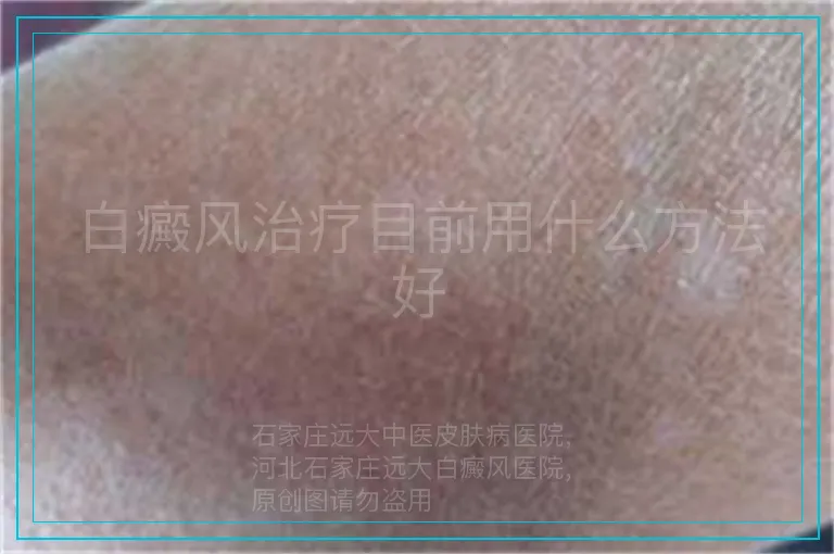 白癜风治疗目前用什么方法好