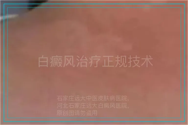 白癜风治疗正规技术