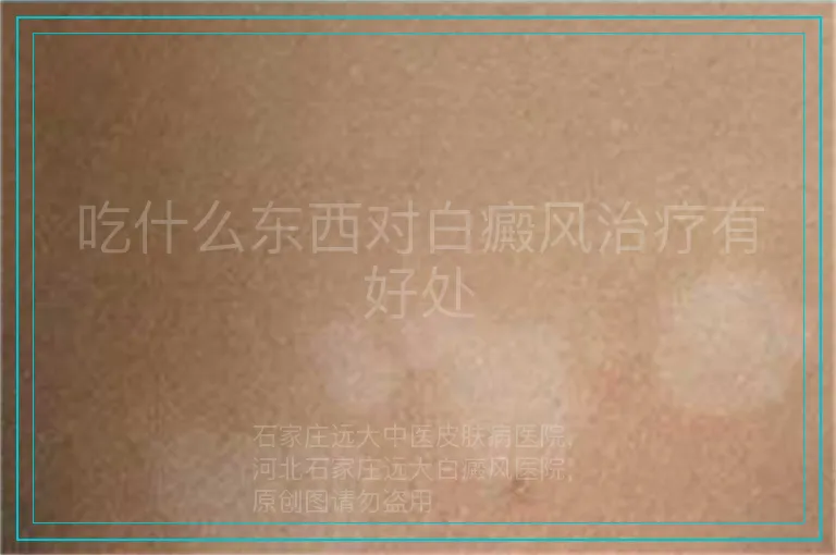 吃什么东西对白癜风治疗有好处