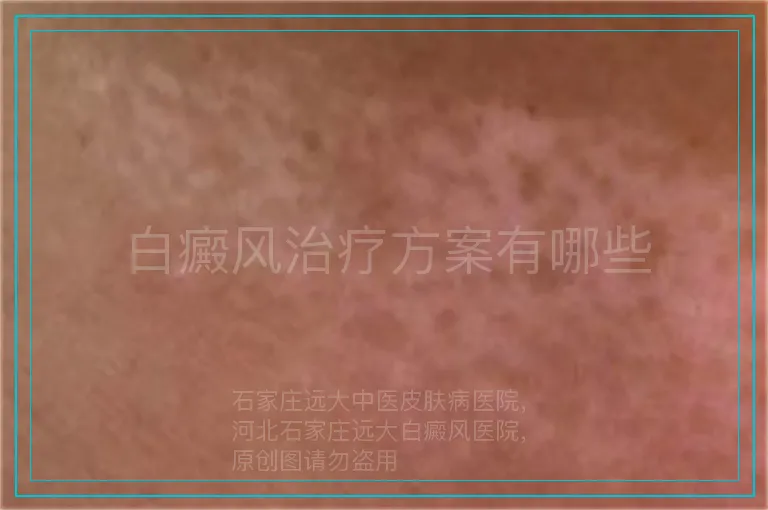 白癜风治疗方案有哪些