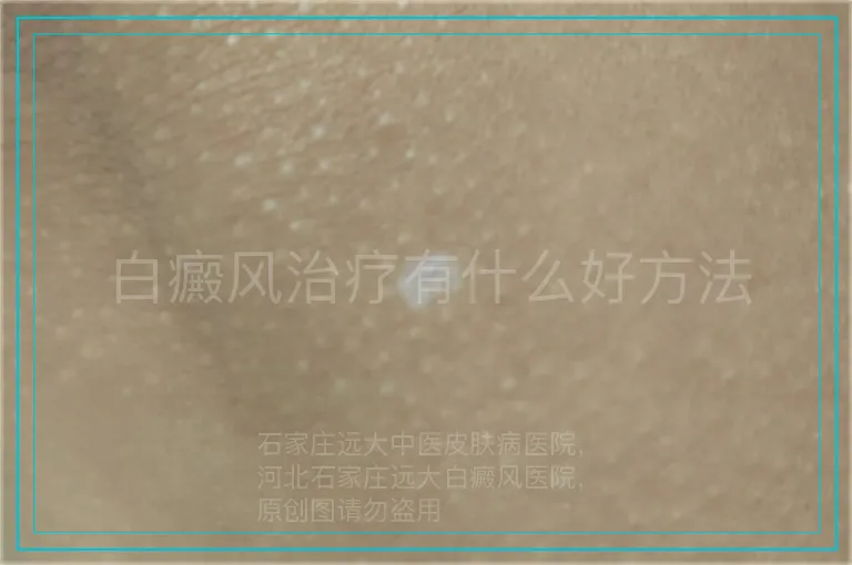 白癜风治疗有什么好方法