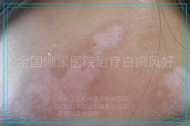 全国哪家医院治疗白癜风好