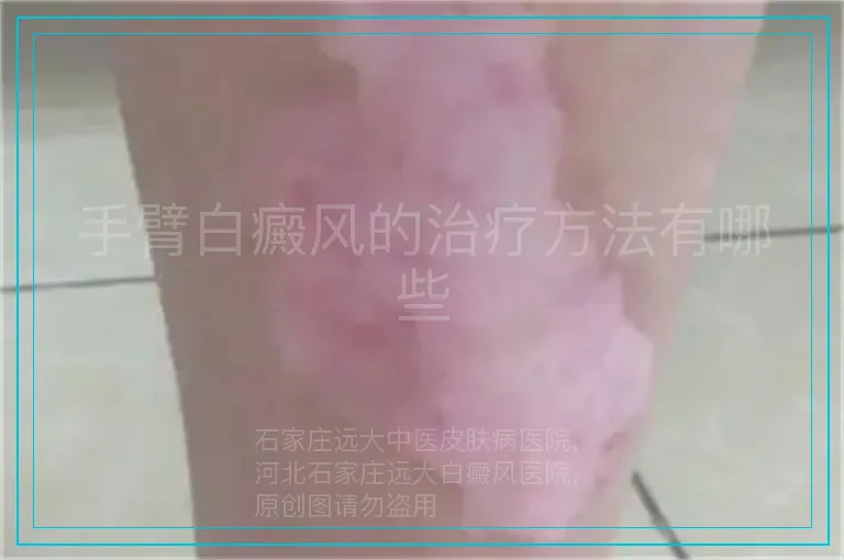 手臂白癜风的治疗方法有哪些