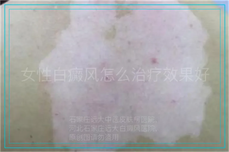 女性白癜风怎么治疗效果好