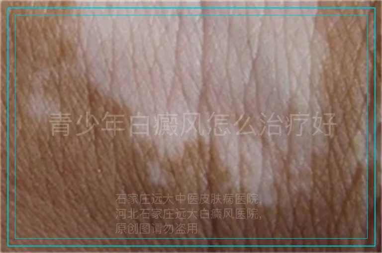 青少年白癜风怎么治疗好