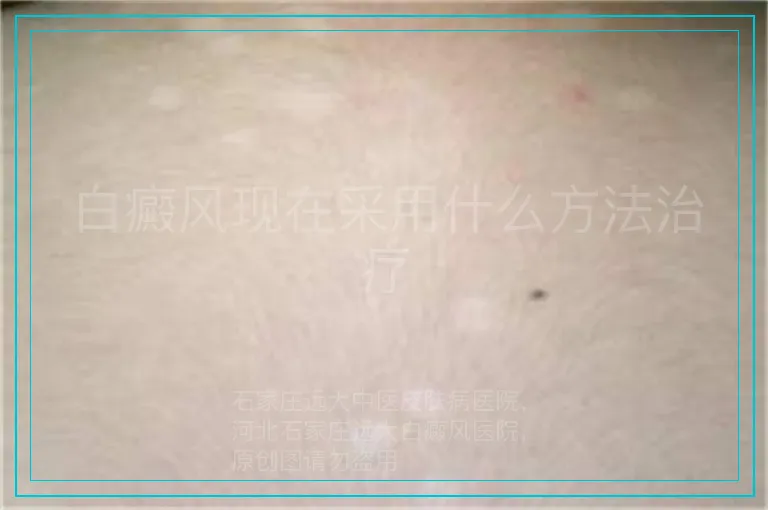 白癜风现在采用什么方法治疗
