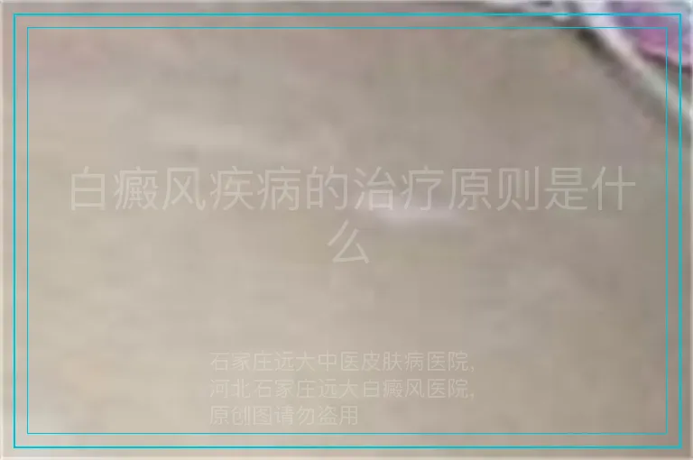 白癜风疾病的治疗原则是什么