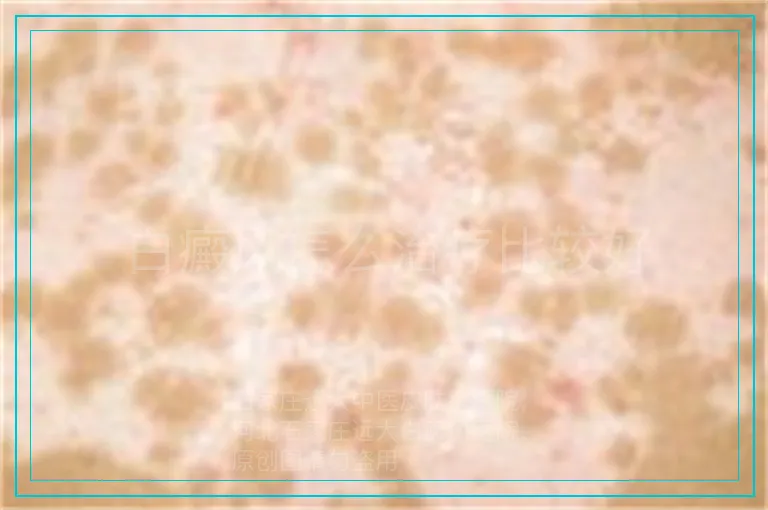白癜风怎么治疗比较好