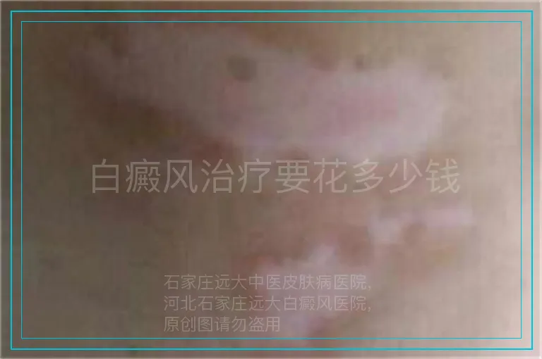 白癜风治疗要花多少钱