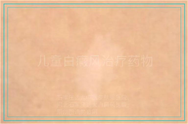 儿童白癜风治疗药物