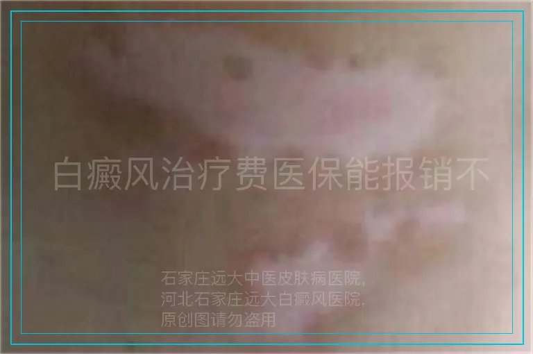 白癜风治疗费医保能报销不