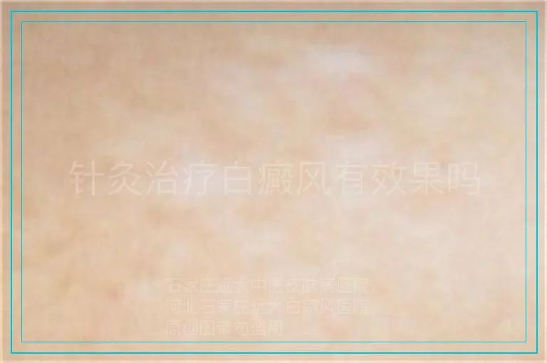 针灸治疗白癜风有效果吗
