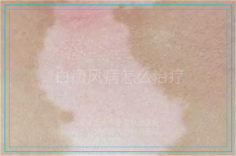 白癜风病怎么治疗