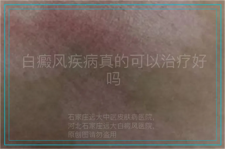 白癜风疾病真的可以治疗好吗