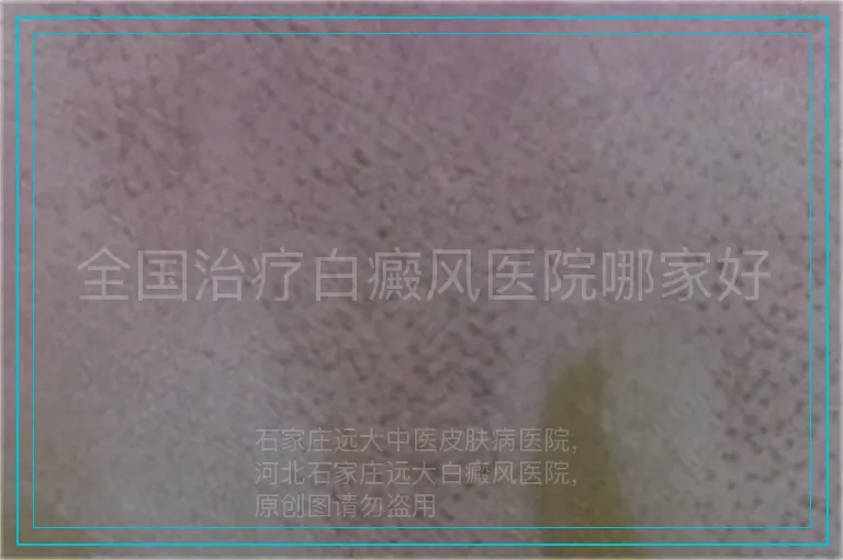 全国治疗白癜风医院哪家好