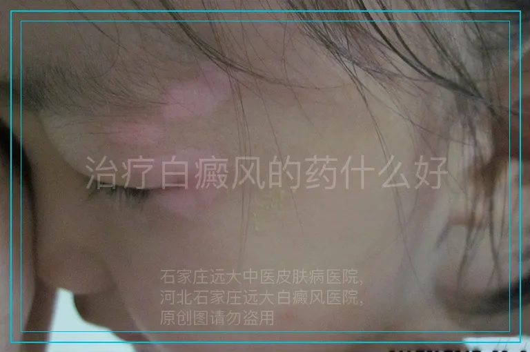 治疗白癜风的药什么好